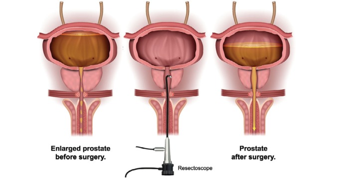 Transurethral Resection of the Prostate (TURP) Image