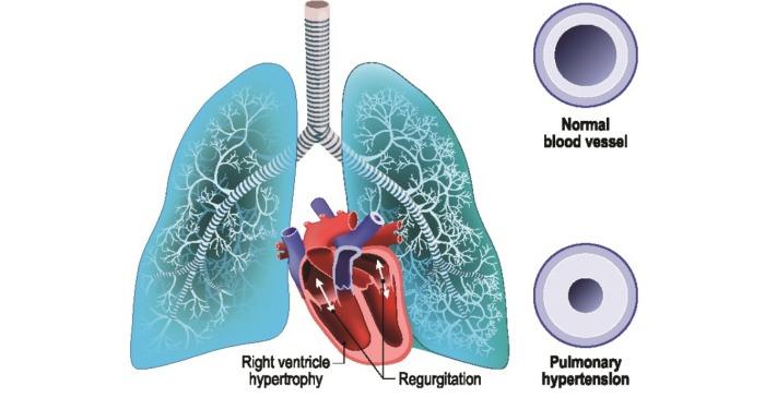 Pulmonary Hypertension Symptoms, Causes, Risk Factors