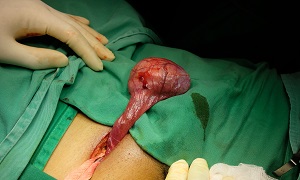 Surgery testicle removal Orchiectomy Image
