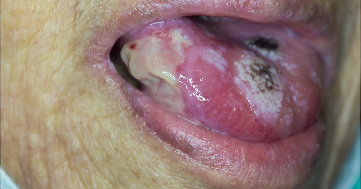 Tongue Cancer Image
