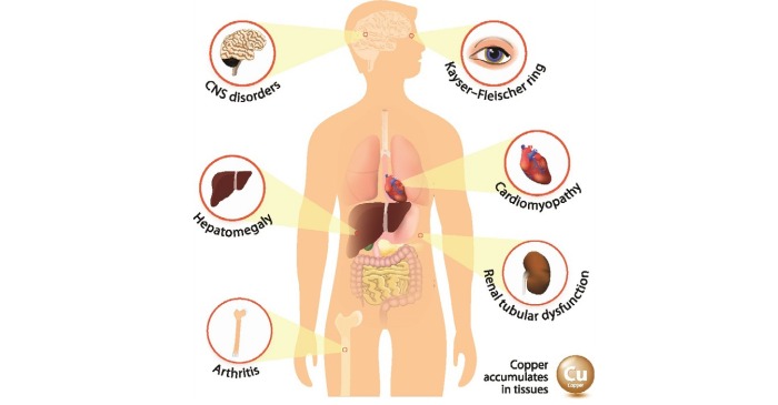 Wilson’s disease: Symptoms, Causes, Risk Factors , Diagnosis, Treatment