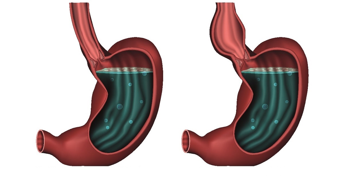 Achalasia - 1200