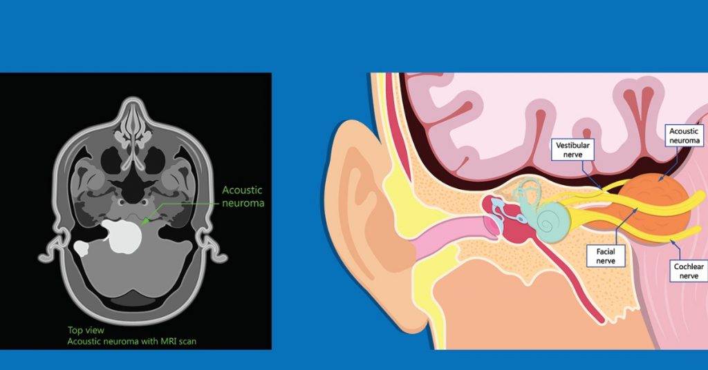 Acoustic Neuroma Image