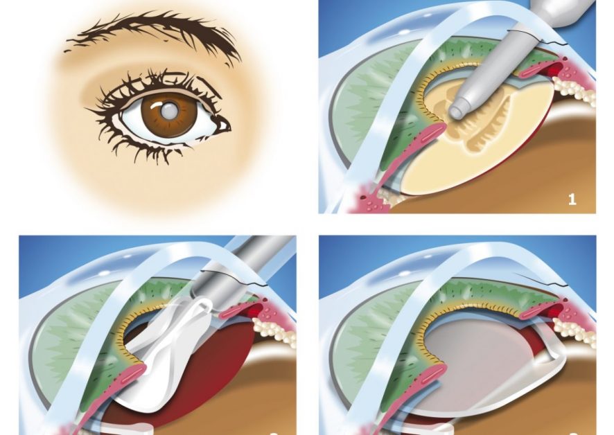 Мыть голову после операции катаракты