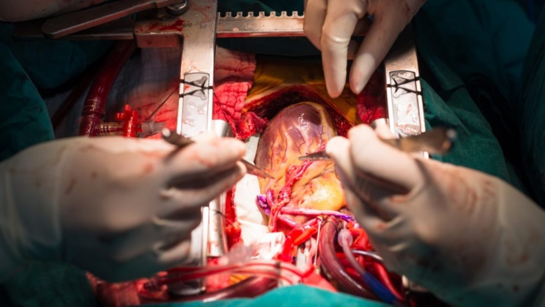 Minimally Invasive Heart Surgery image