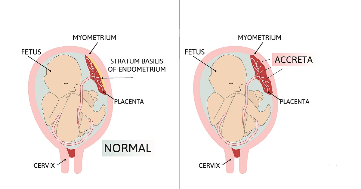 Placenta Accreta Image