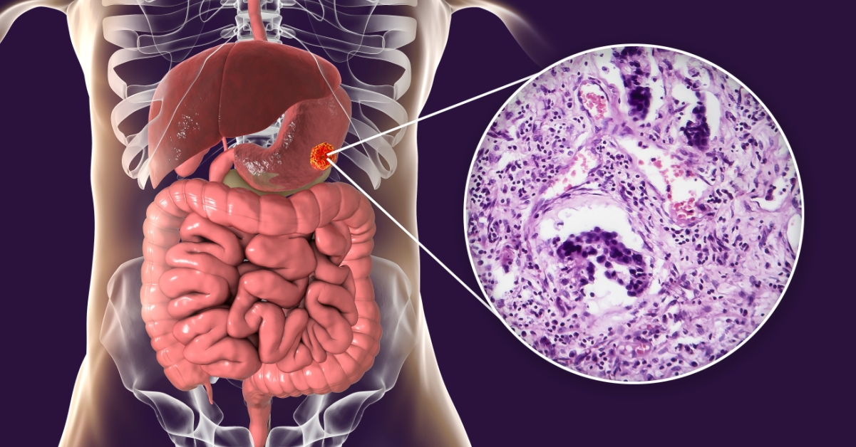 Adenocarcinoma image