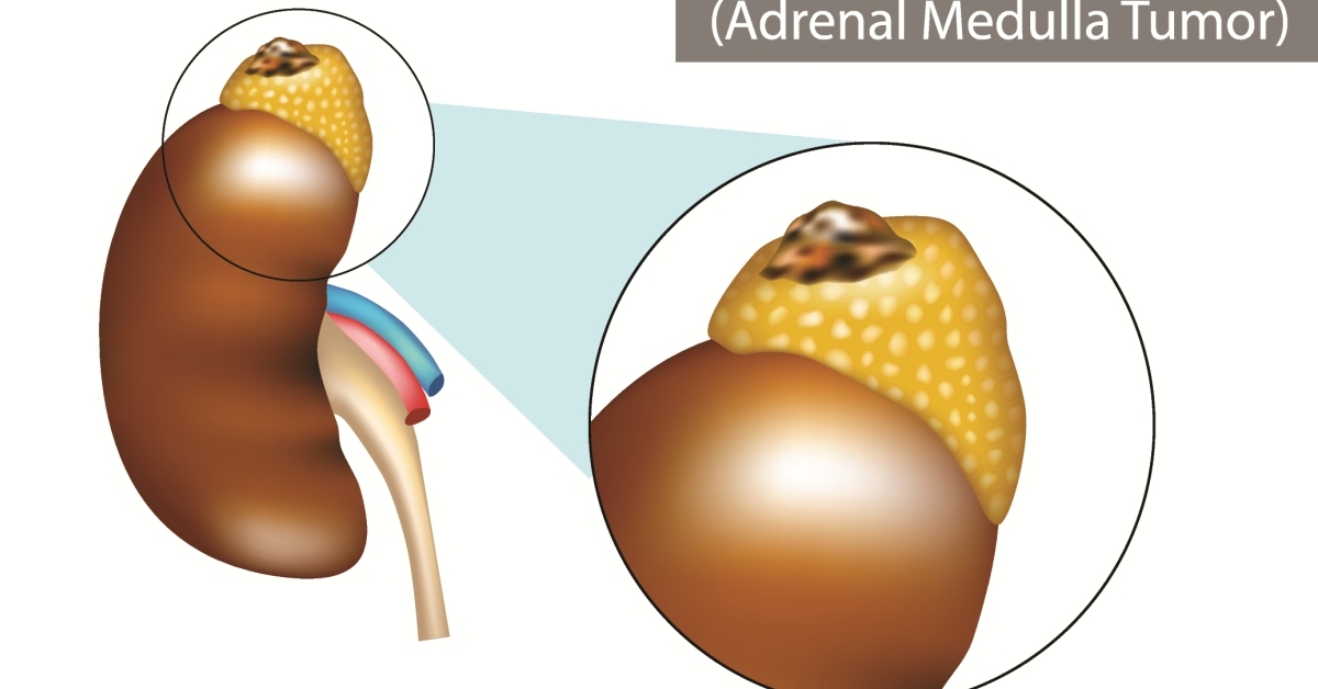 Adrenal Cancer image