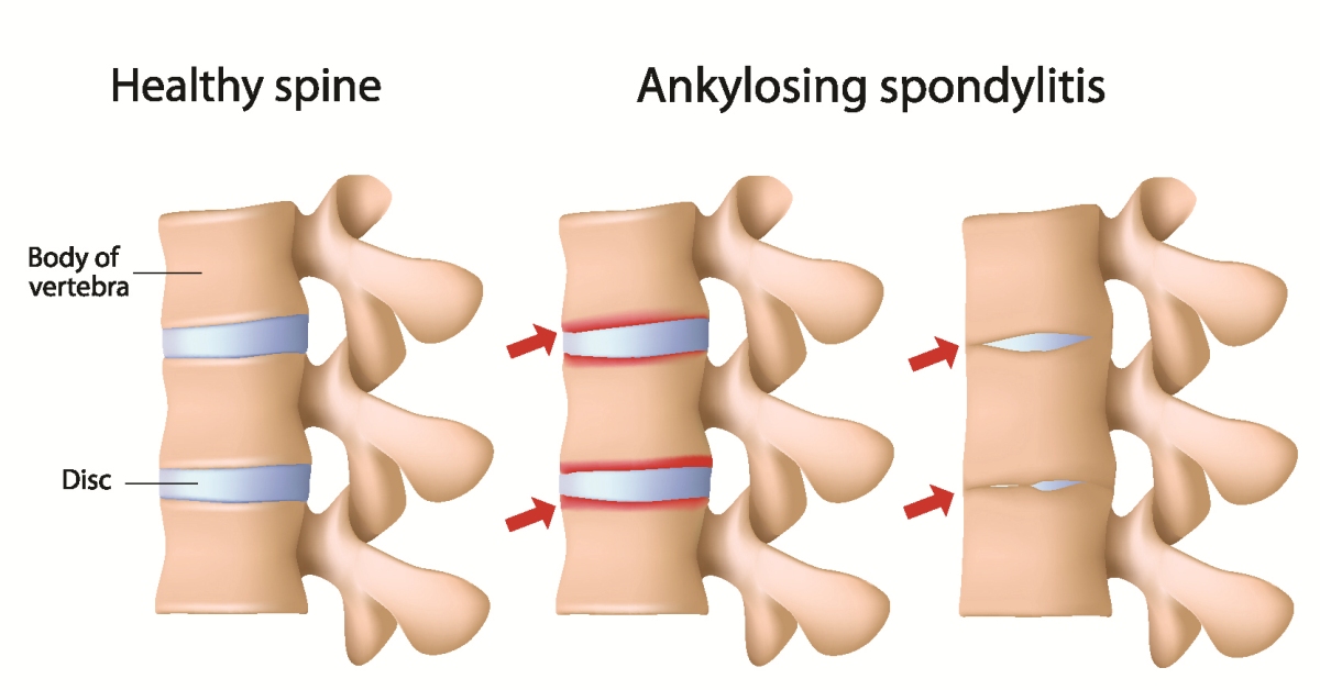 Ankylosing Spondylitis image