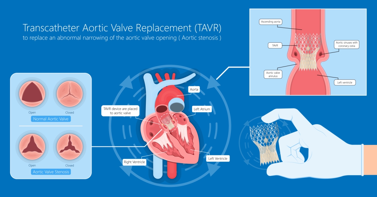 Aortic Valve Regurgitation image