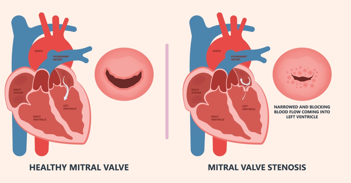 Aortic Valve Stenosis image