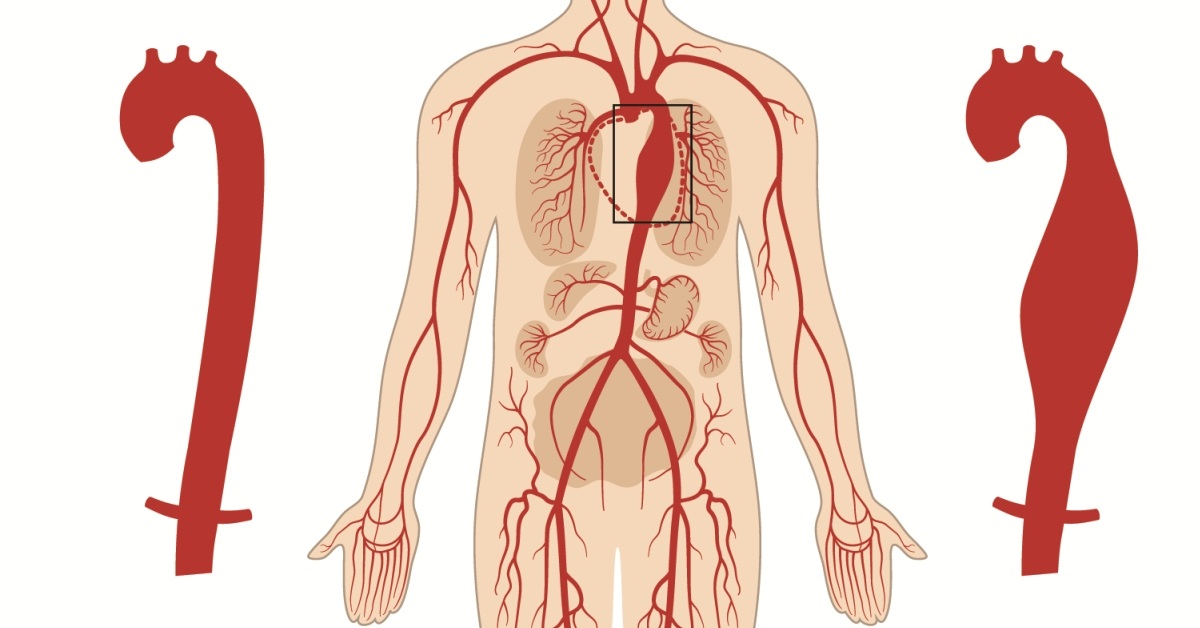 Arterial Aneurysm image