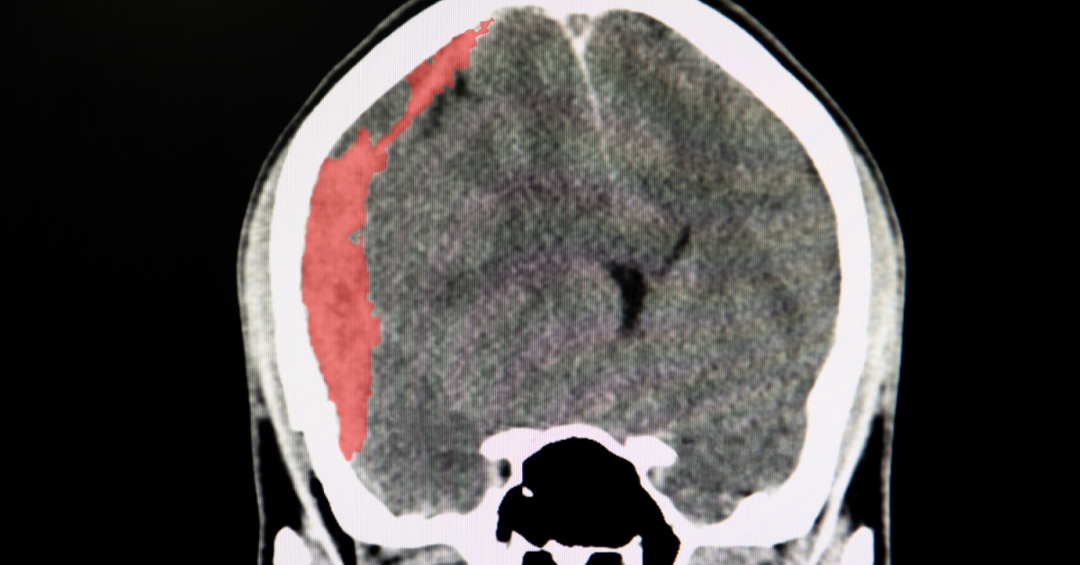 Astrocytoma image