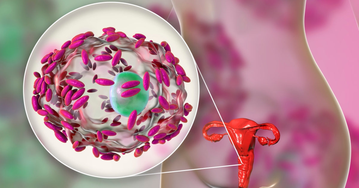 Bacterial Vaginosis image