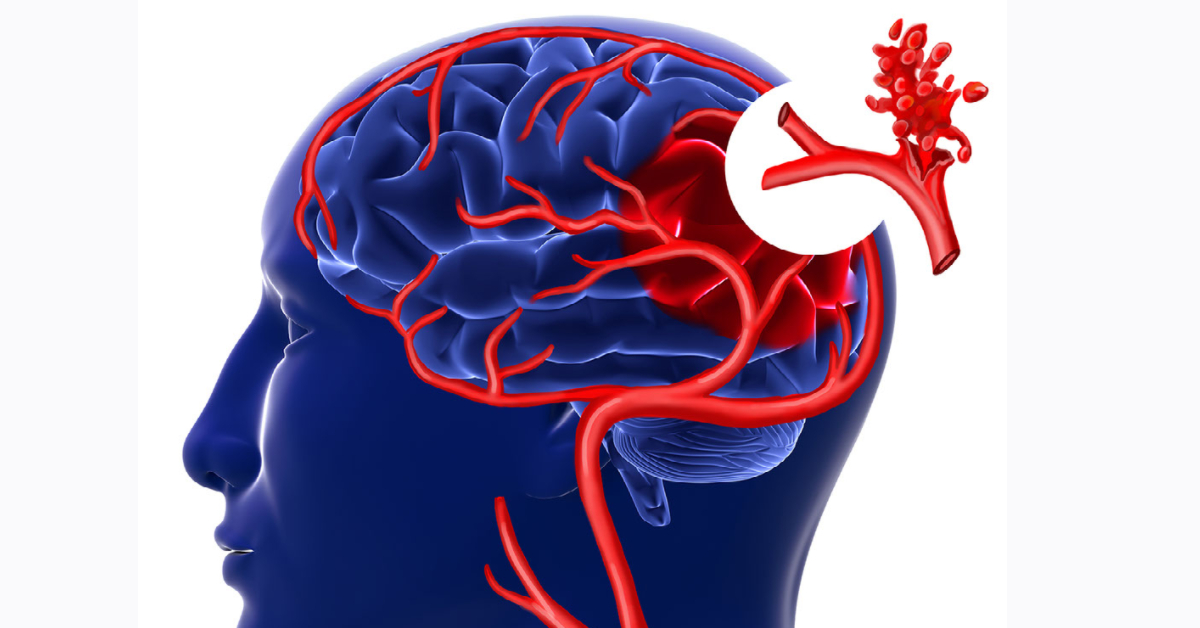 Brain Aneurysm Image