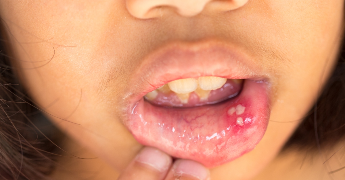 Canker Sore image