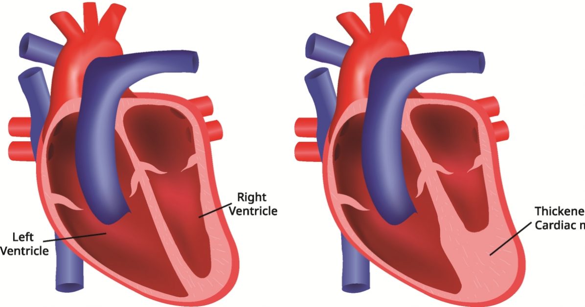 Cardiomyopathy image