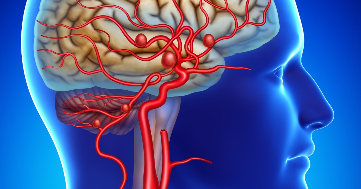 Carotid Artery image
