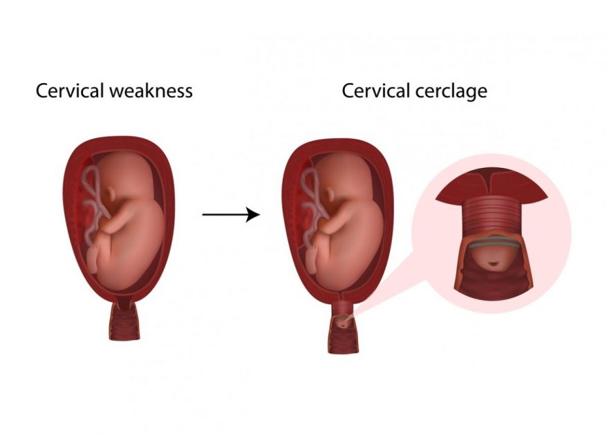Cervical Cerclage image