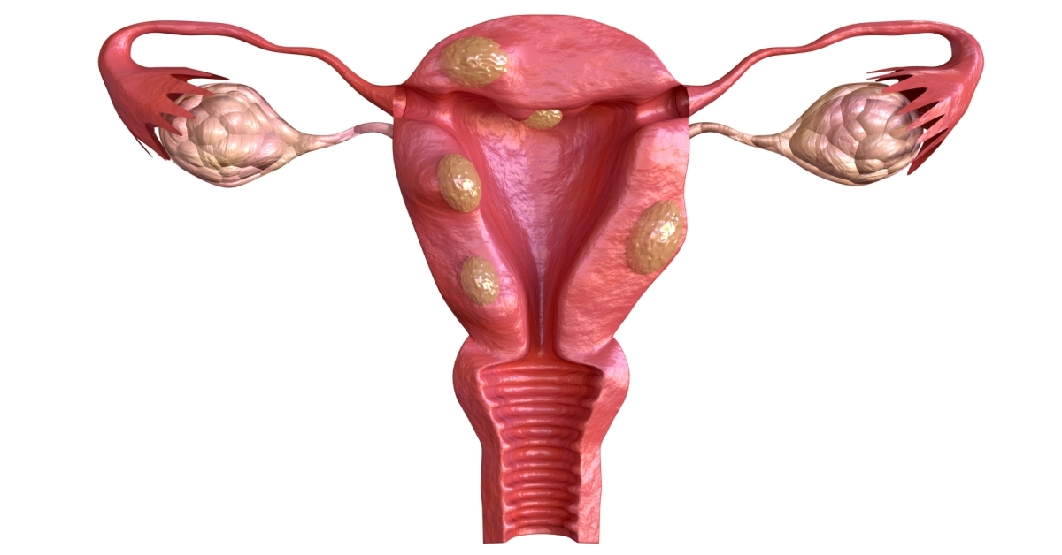 Cervical Dysplasia image