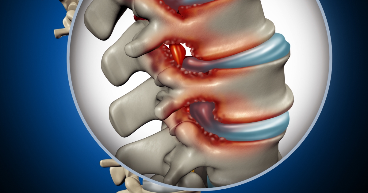 Cervical Spinal Stenosis image