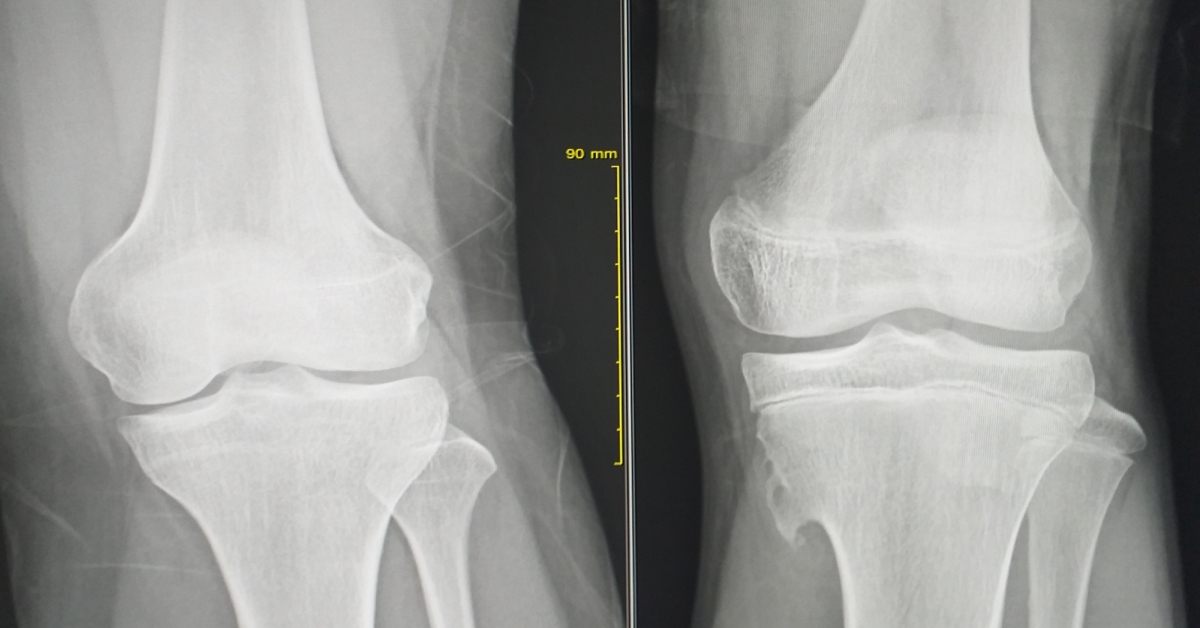 Chondrosarcoma image