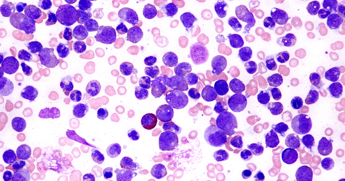 Chronic Myelogenous Leukemia image