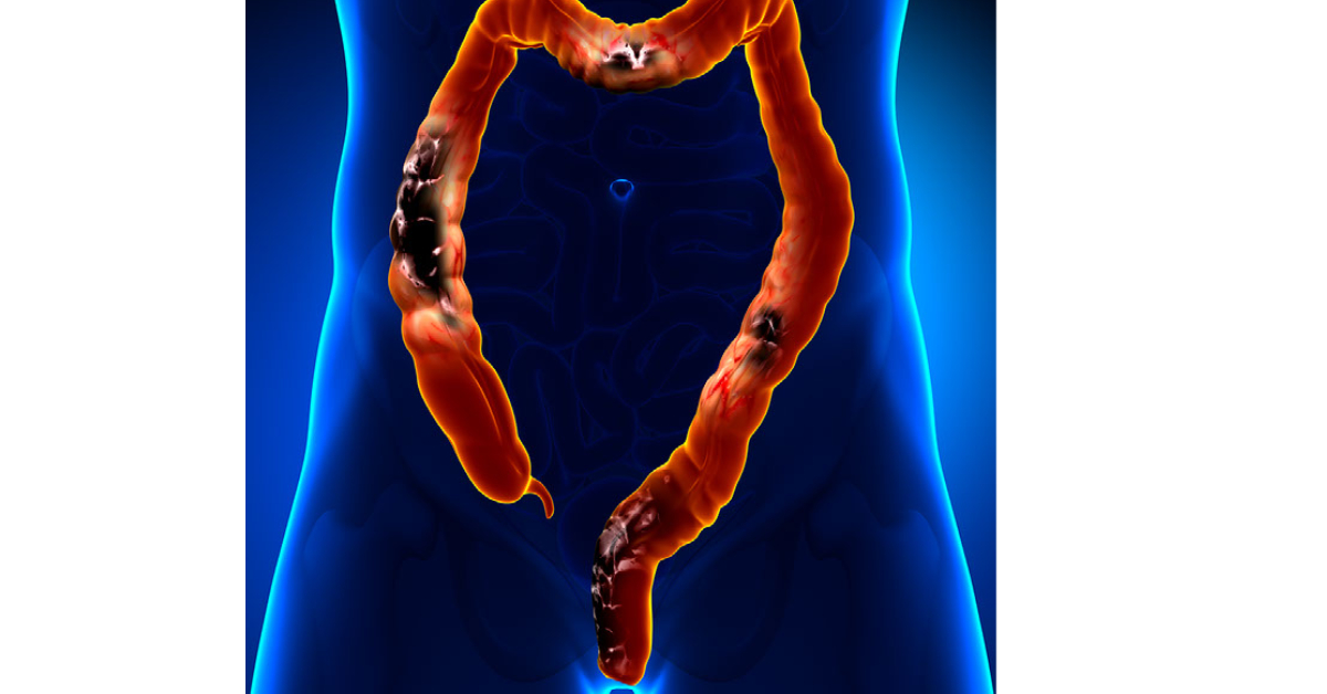 Colon Cancer Image