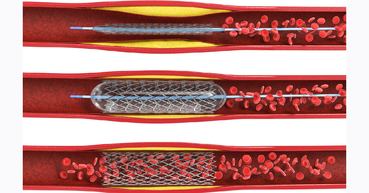 Coronary Angioplasty Image