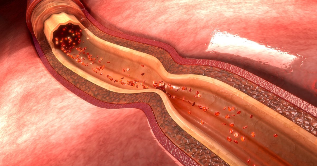 Coronary Artery Spasm image