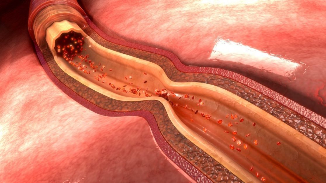 Coronary Artery image