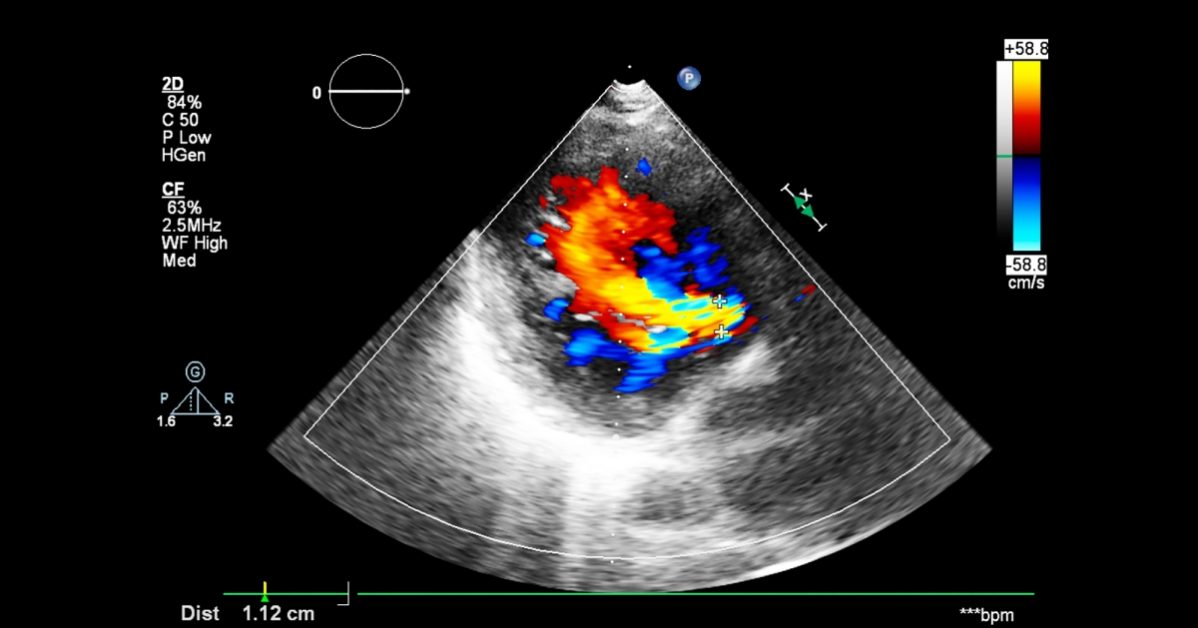 Doppler Echocardiography image