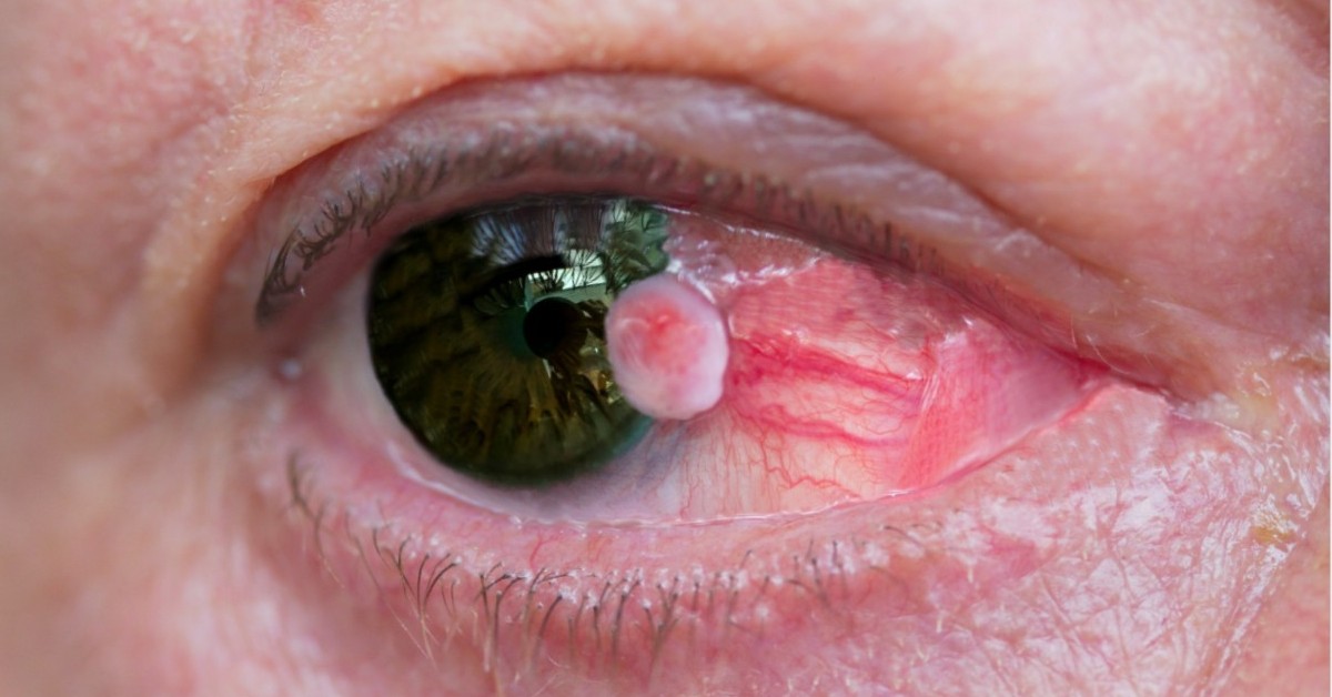 Eye Cancer image