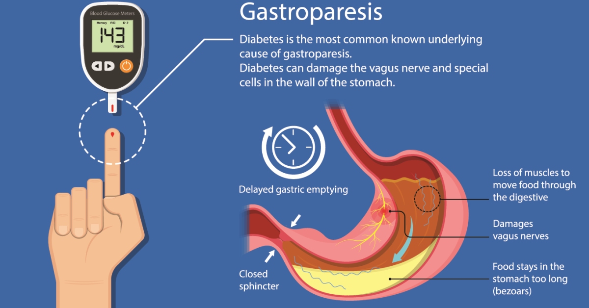 Gastroparesis image