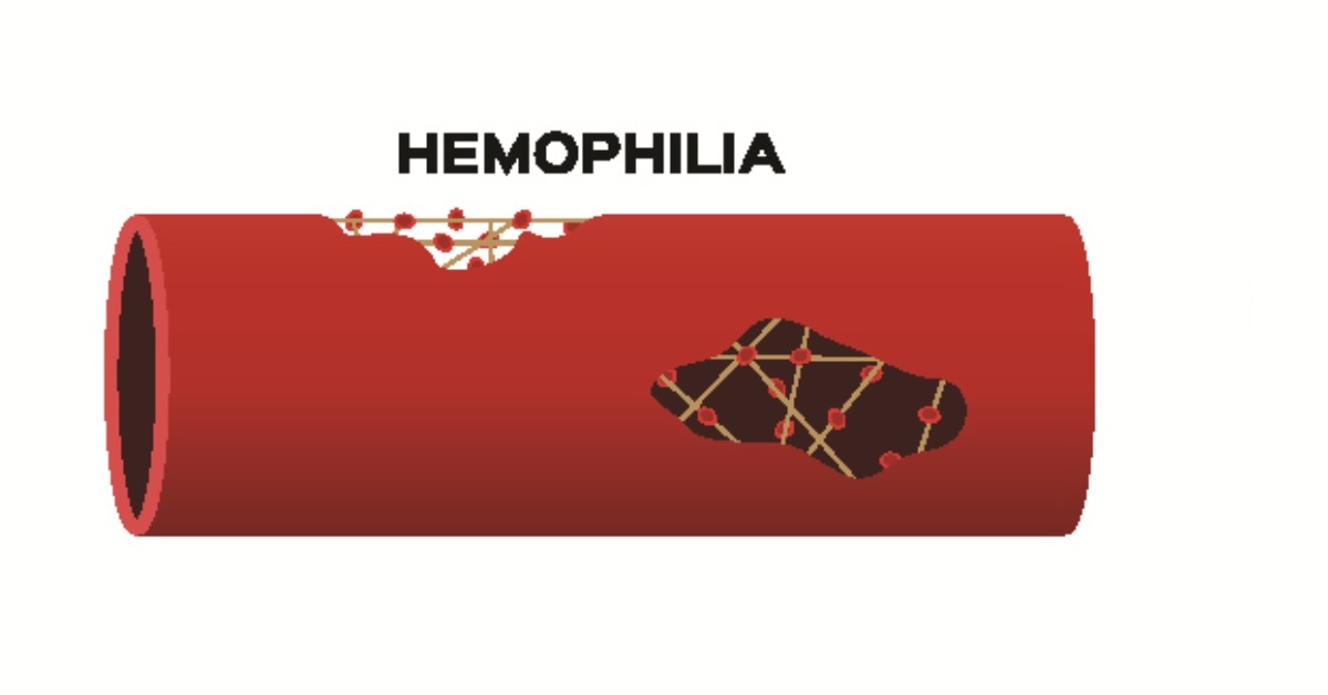 Hemophilia image