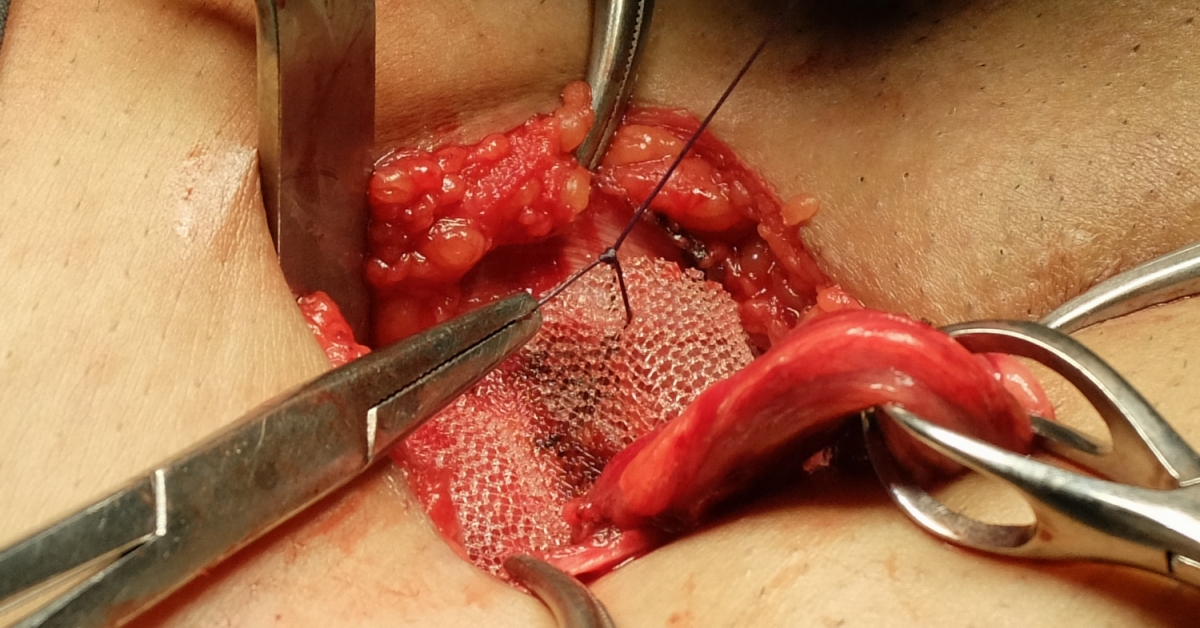 Hernia Surgery image