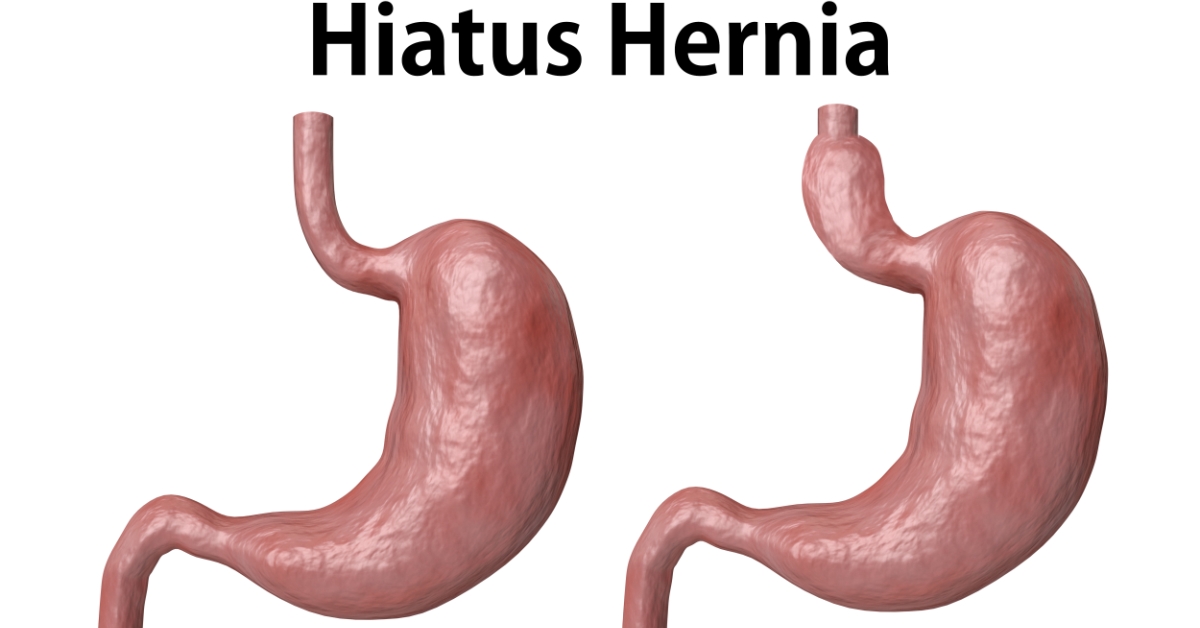 Hiatal Hernia image
