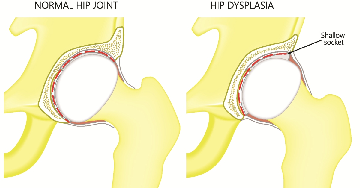 Hip Dysplasia image