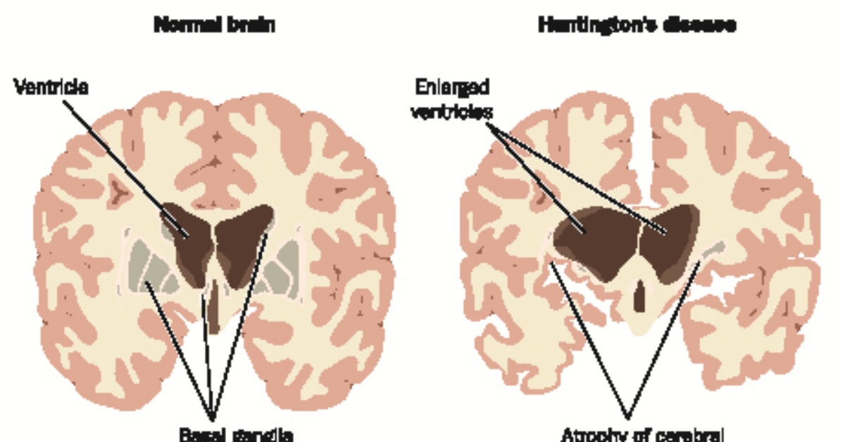 Huntington's Disease image