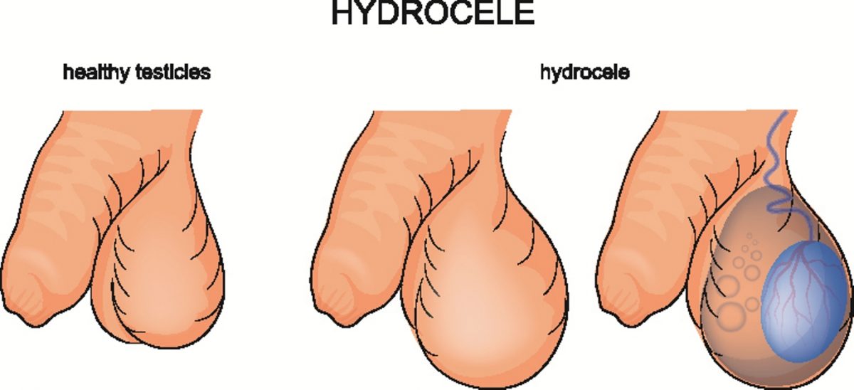 Hydrocele image