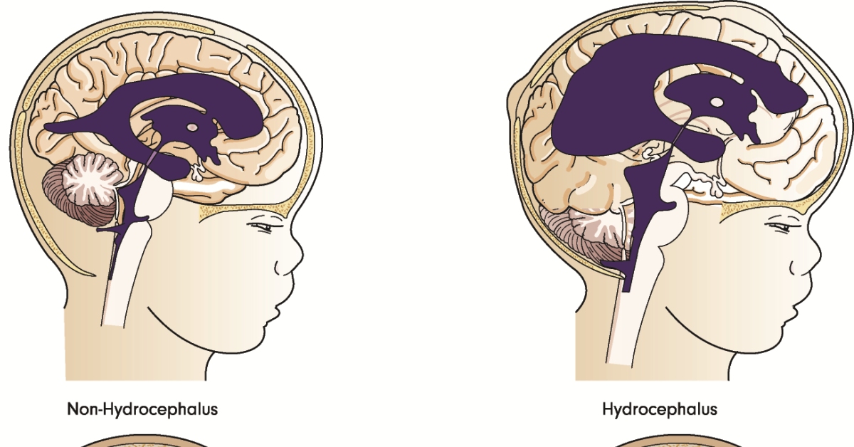 Best Drs & Hospitals in India for Hydrocephalus Treatment