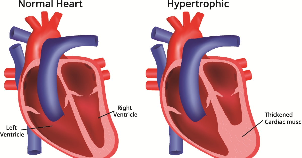Hypertrophic Cardiomyopathy image