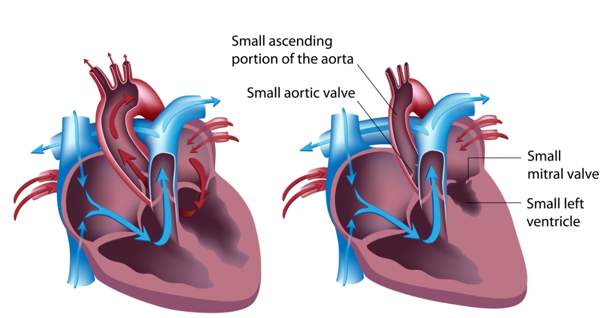 Hypoplastic Left Heart image