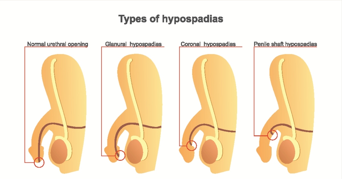 Hypospadias image