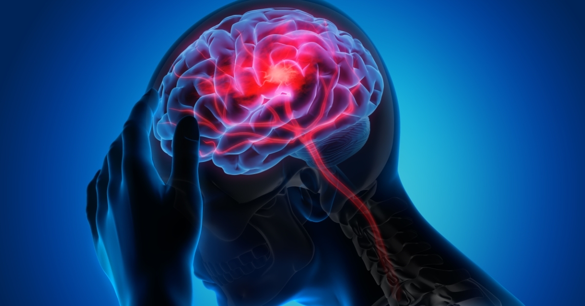 Intracerebral Hemorrhage image