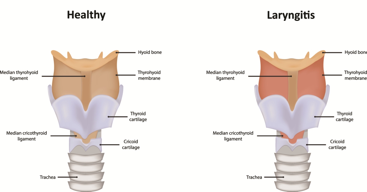 Laryngitis image