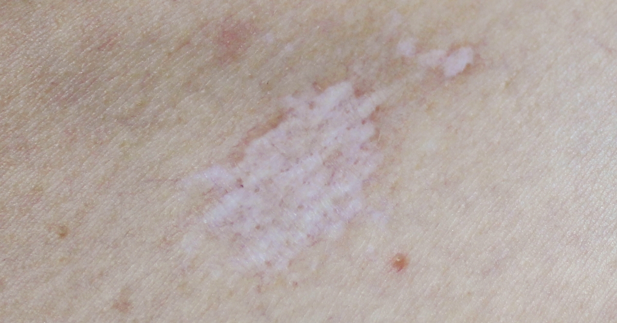 Lichen Sclerosus image