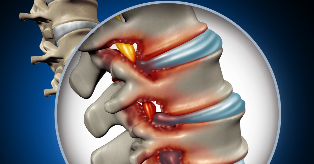Lumbar Spinal Stenosis image