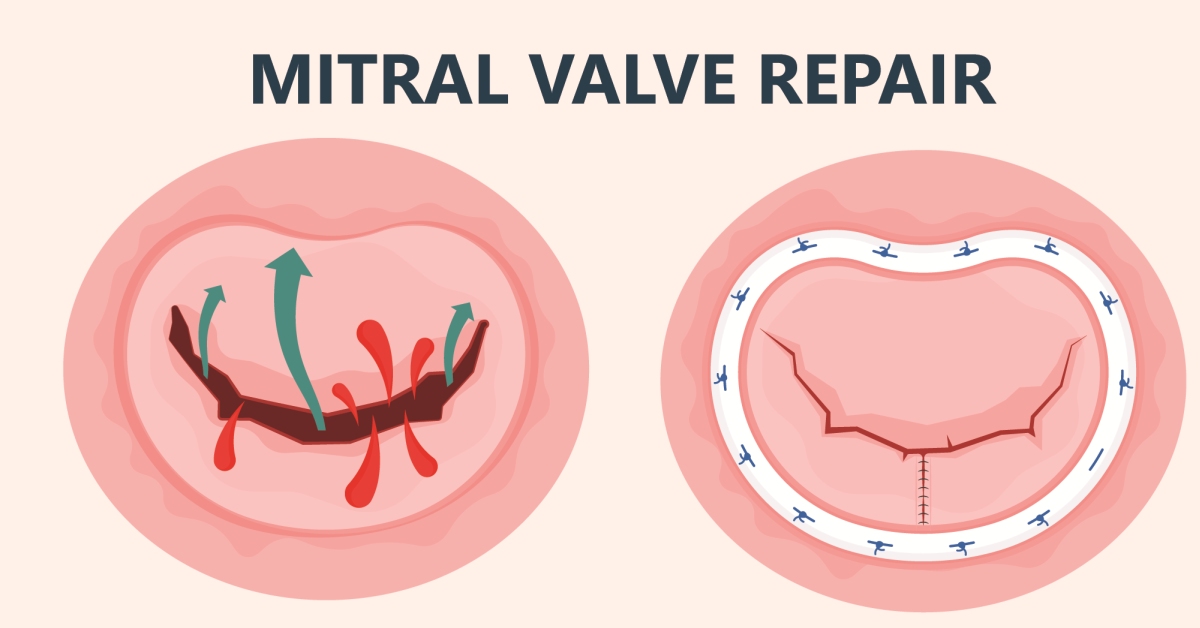 Mitral valve image
