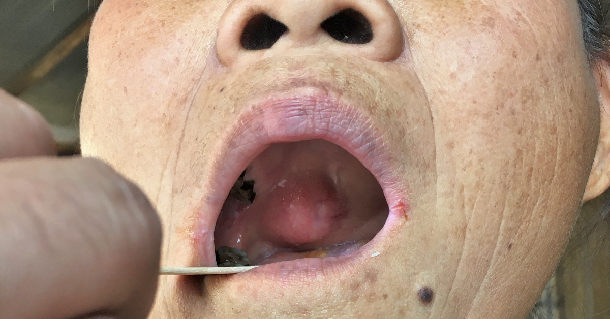 Mouth Tumors image